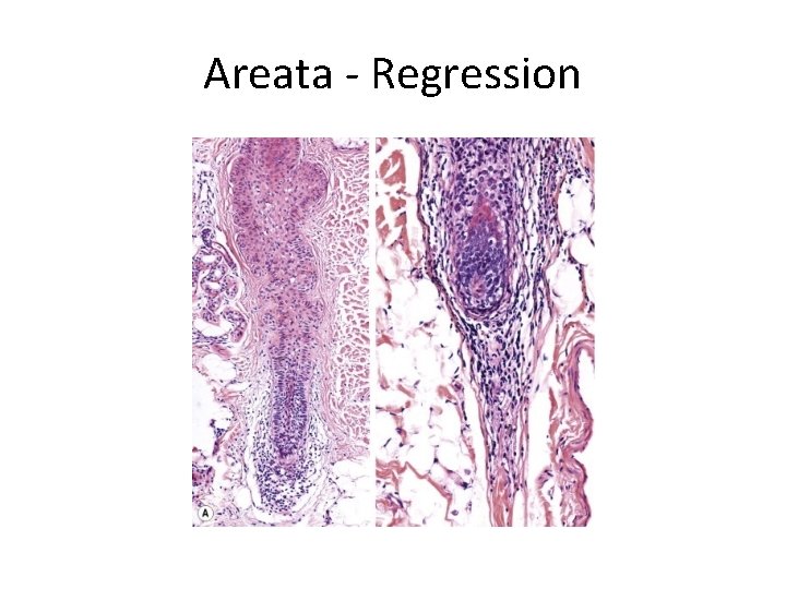 Areata - Regression 