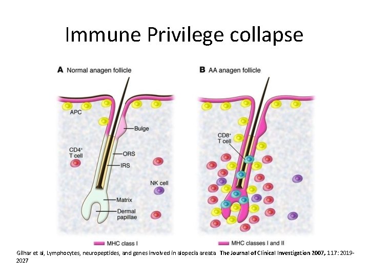 Immune Privilege collapse Gilhar et al, Lymphocytes, neuropeptides, and genes involved in alopecia areata.