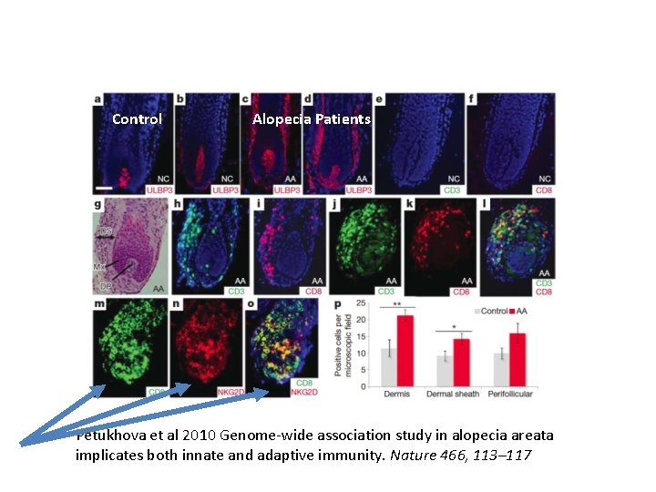 Control Alopecia Patients Petukhova et al 2010 Genome-wide association study in alopecia areata implicates