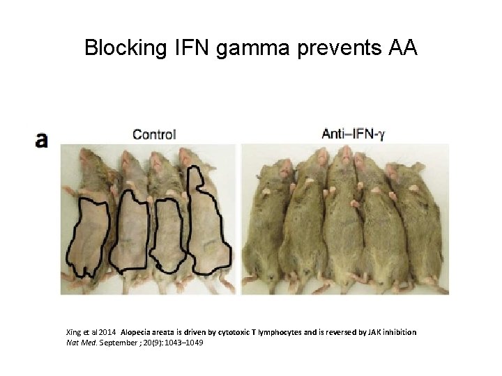 Blocking IFN gamma prevents AA Xing et al 2014 Alopecia areata is driven by