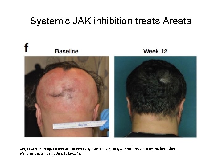 Systemic JAK inhibition treats Areata Xing et al 2014 Alopecia areata is driven by