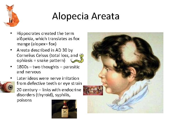 Alopecia Areata • Hippocrates created the term alōpekia, which translates as fox mange (alopex=