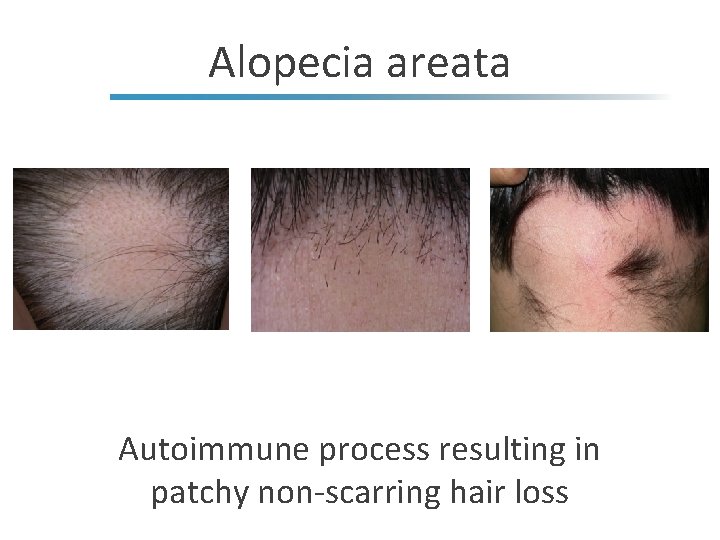 Alopecia areata Autoimmune process resulting in patchy non-scarring hair loss 