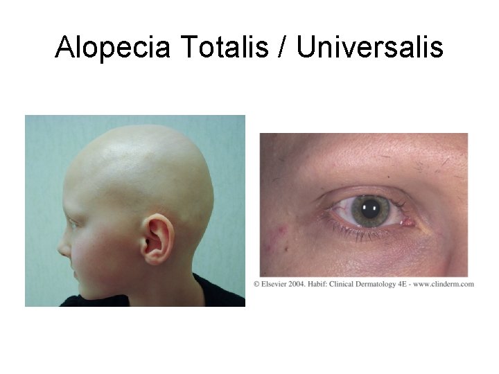 Alopecia Totalis / Universalis 