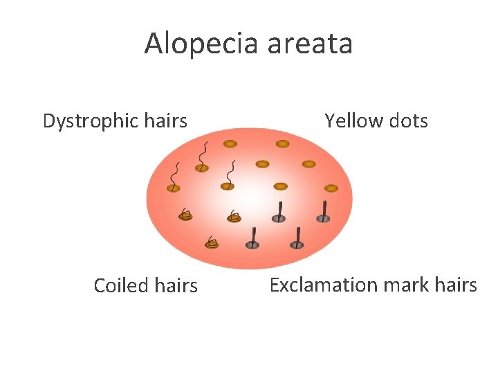 Alopecia areata Dystrophic hairs Coiled hairs Yellow dots Exclamation mark hairs 