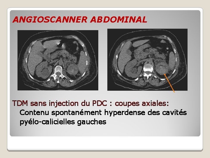 ANGIOSCANNER ABDOMINAL TDM sans injection du PDC : coupes axiales: Contenu spontanément hyperdense des