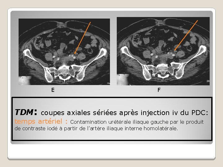E F TDM: coupes axiales sériées après injection iv du PDC: temps artériel :
