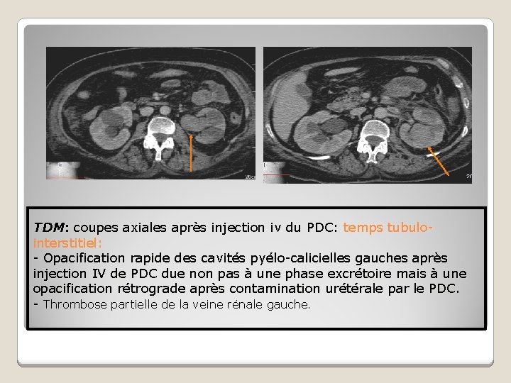 TDM: coupes axiales après injection iv du PDC: temps tubulointerstitiel: - Opacification rapide des