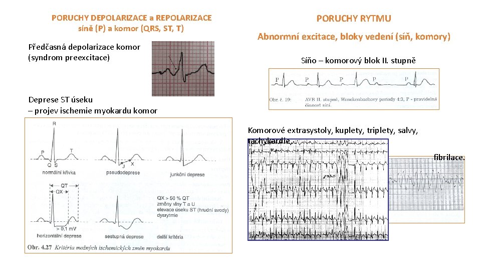 PORUCHY DEPOLARIZACE a REPOLARIZACE síně (P) a komor (QRS, ST, T) Předčasná depolarizace komor