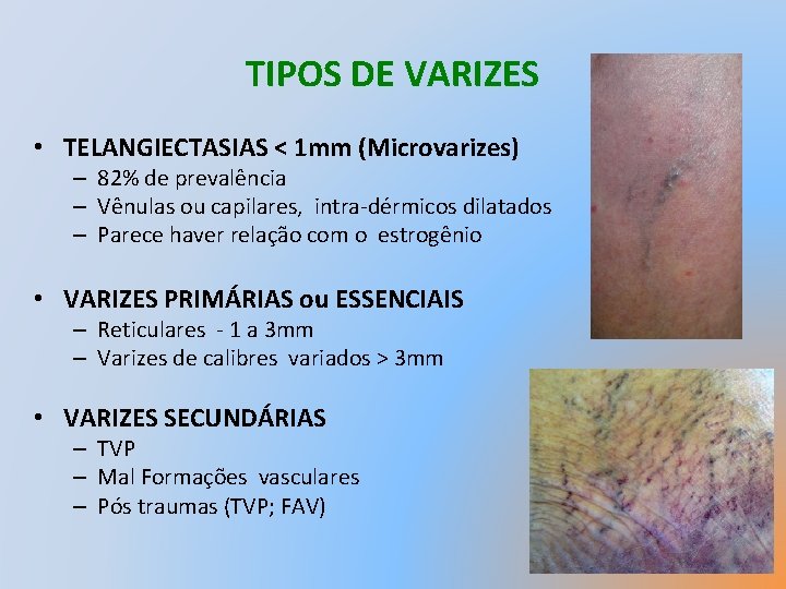 TIPOS DE VARIZES • TELANGIECTASIAS < 1 mm (Microvarizes) – 82% de prevalência –