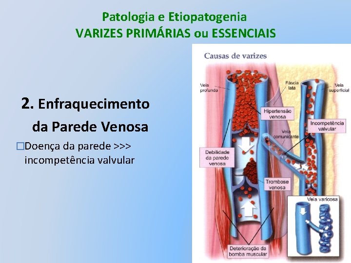 Patologia e Etiopatogenia VARIZES PRIMÁRIAS ou ESSENCIAIS 2. Enfraquecimento da Parede Venosa �Doença da