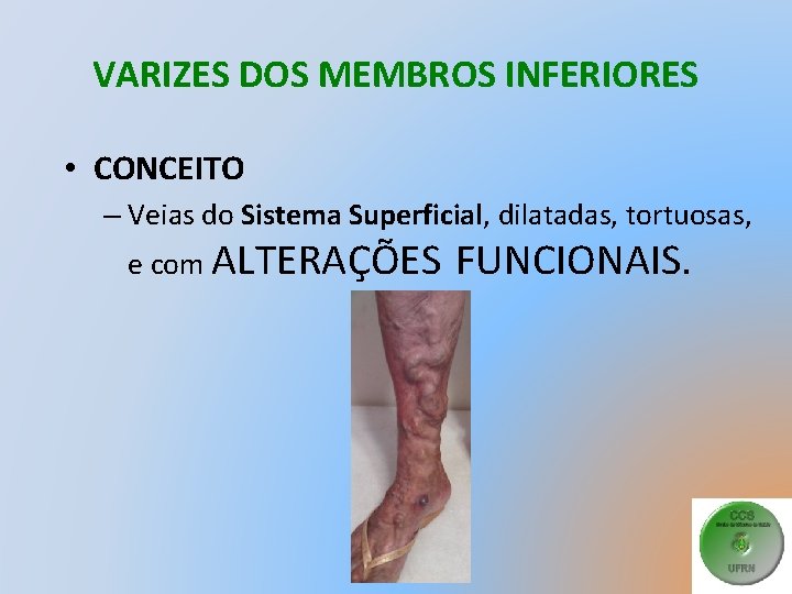 VARIZES DOS MEMBROS INFERIORES • CONCEITO – Veias do Sistema Superficial, dilatadas, tortuosas, e