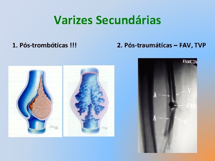 Varizes Secundárias 1. Pós-trombóticas !!! 2. Pós-traumáticas – FAV, TVP 