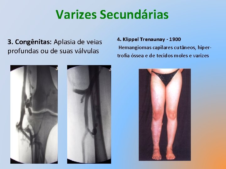 Varizes Secundárias 3. Congênitas: Aplasia de veias profundas ou de suas válvulas 4. Klippel