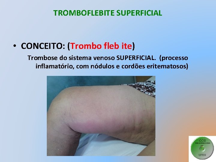 TROMBOFLEBITE SUPERFICIAL • CONCEITO: (Trombo fleb ite) Trombose do sistema venoso SUPERFICIAL. (processo inflamatório,