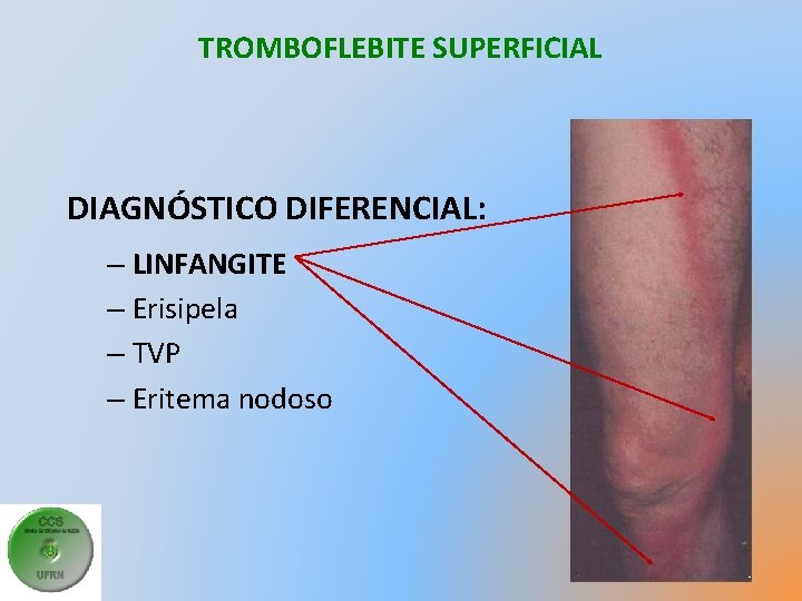 TROMBOFLEBITE SUPERFICIAL DIAGNÓSTICO DIFERENCIAL: – LINFANGITE – Erisipela – TVP – Eritema nodoso 