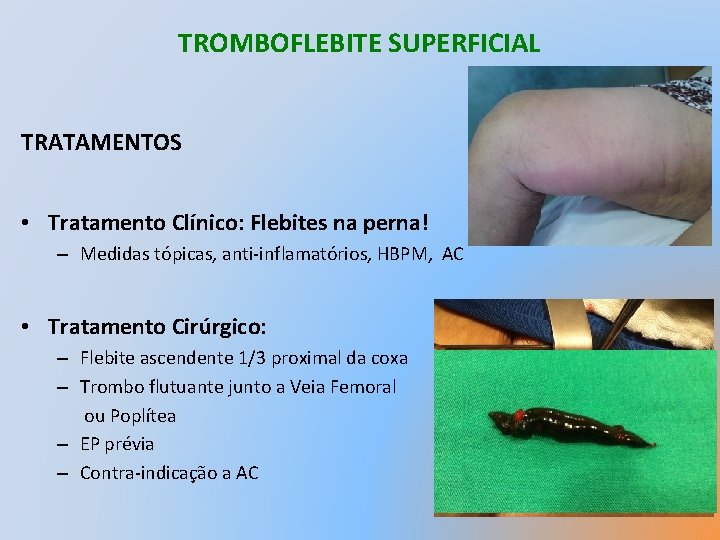 TROMBOFLEBITE SUPERFICIAL TRATAMENTOS • Tratamento Clínico: Flebites na perna! – Medidas tópicas, anti-inflamatórios, HBPM,