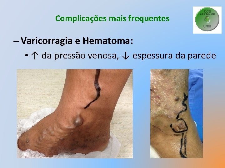 Complicações mais frequentes – Varicorragia e Hematoma: • ↑ da pressão venosa, ↓ espessura