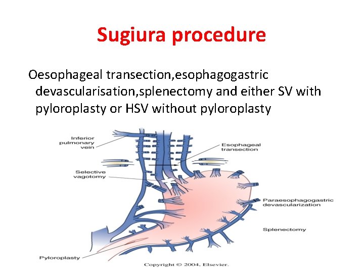 Sugiura procedure Oesophageal transection, esophagogastric devascularisation, splenectomy and either SV with pyloroplasty or HSV