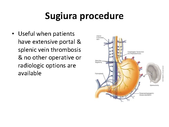 Sugiura procedure • Useful when patients have extensive portal & splenic vein thrombosis &