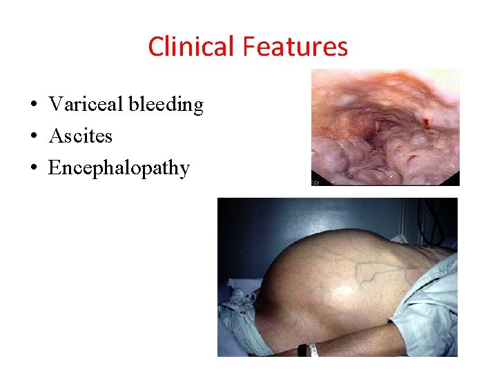 Clinical Features • Variceal bleeding • Ascites • Encephalopathy 