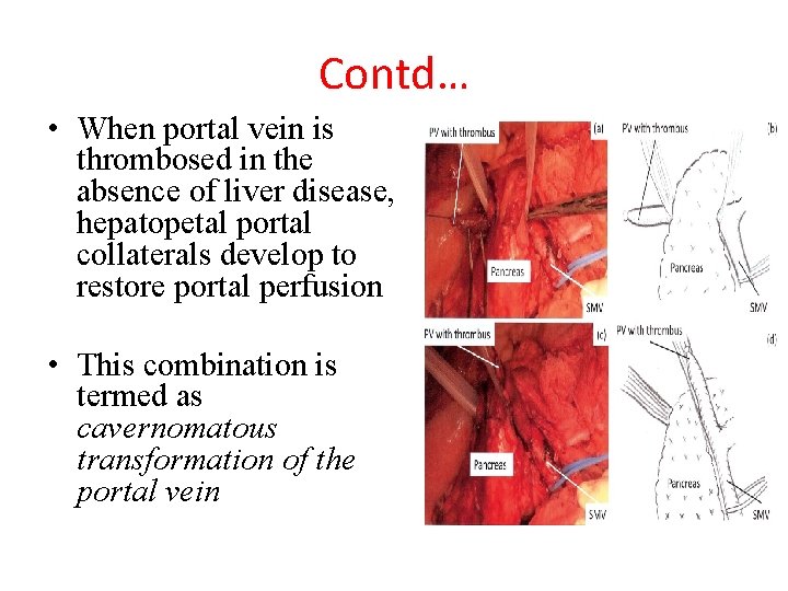 Contd… • When portal vein is thrombosed in the absence of liver disease, hepatopetal