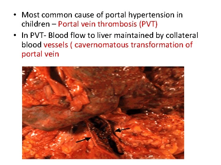  • Most common cause of portal hypertension in children – Portal vein thrombosis