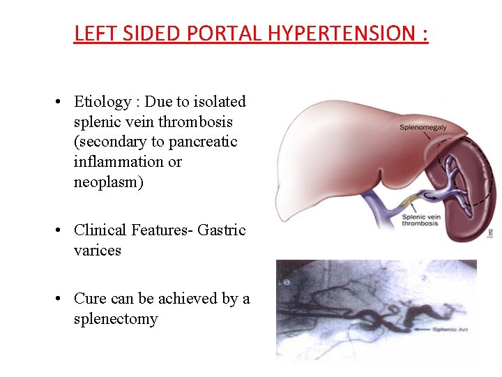 LEFT SIDED PORTAL HYPERTENSION : • Etiology : Due to isolated splenic vein thrombosis