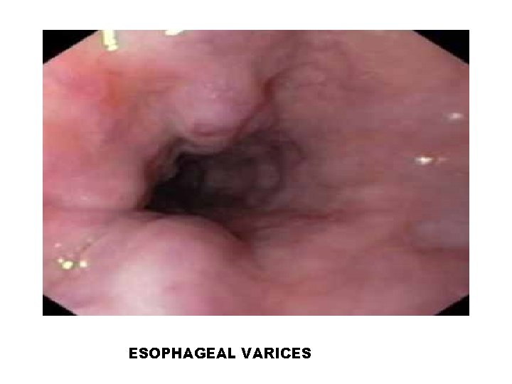 ESOPHAGEAL VARICES 