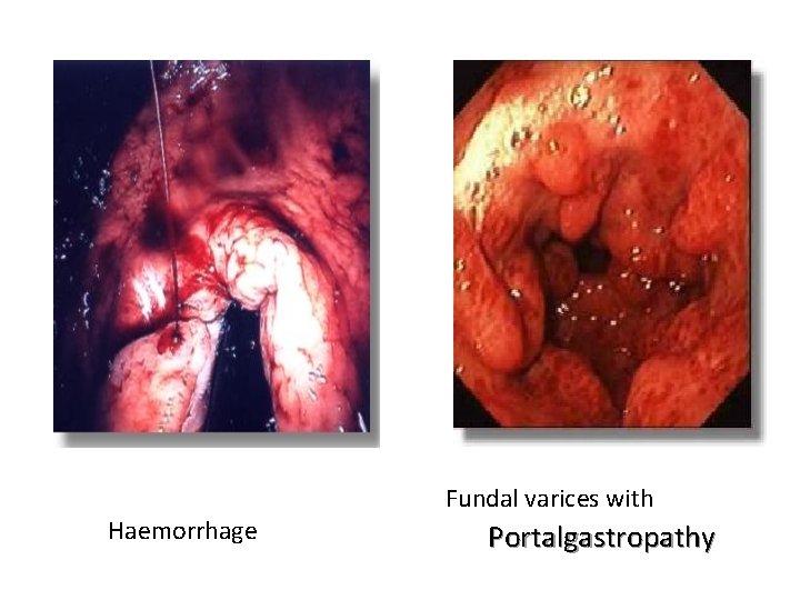 Haemorrhage Fundal varices with Portalgastropathy 