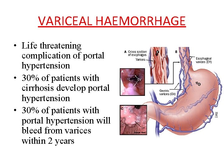 VARICEAL HAEMORRHAGE • Life threatening complication of portal hypertension • 30% of patients with