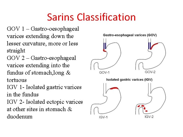 Sarins Classification GOV 1 – Gastro-oesophageal varices extending down the lesser curvature, more or