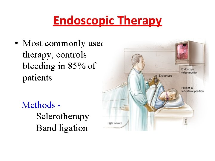 Endoscopic Therapy • Most commonly used therapy, controls bleeding in 85% of patients Methods