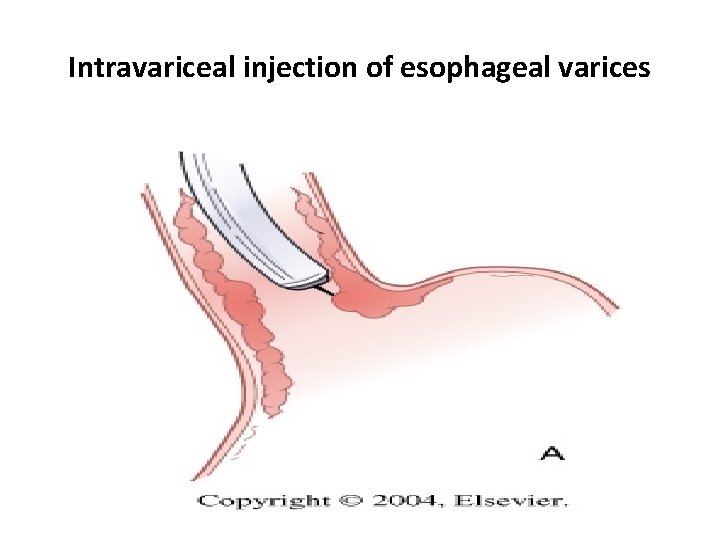 Intravariceal injection of esophageal varices 