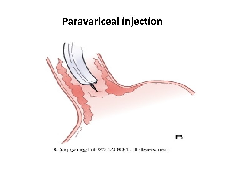 Paravariceal injection 