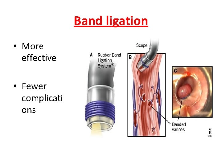 Band ligation • More effective • Fewer complicati ons 