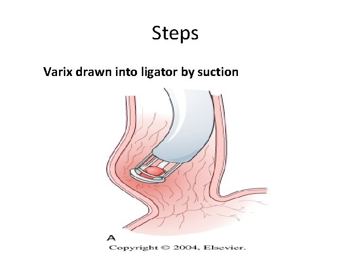 Steps Varix drawn into ligator by suction 