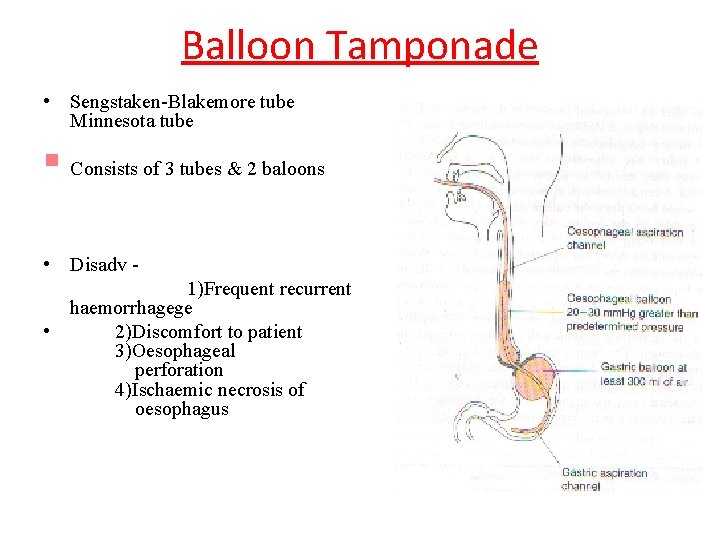 Balloon Tamponade • Sengstaken-Blakemore tube Minnesota tube § Consists of 3 tubes & 2