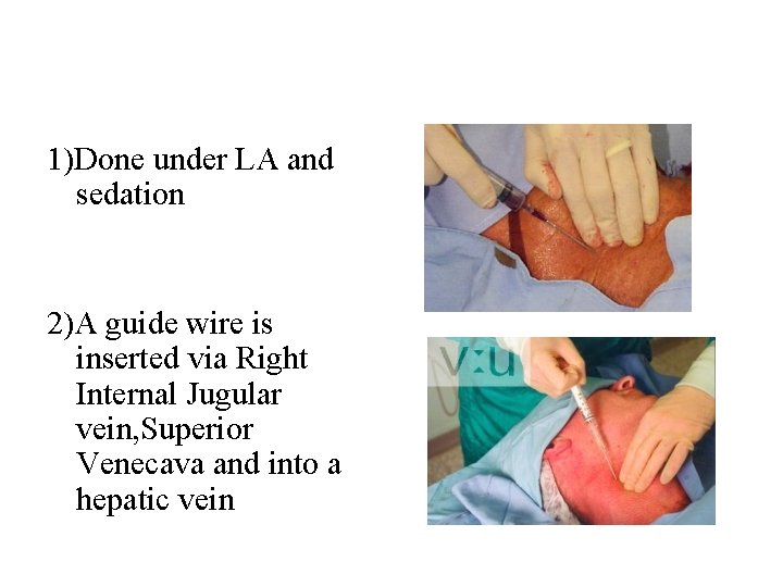1)Done under LA and sedation 2)A guide wire is inserted via Right Internal Jugular