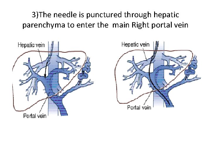 3)The needle is punctured through hepatic parenchyma to enter the main Right portal vein