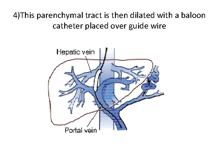 4)This parenchymal tract is then dilated with a baloon catheter placed over guide wire