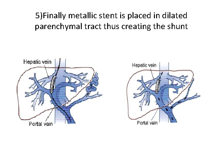 5)Finally metallic stent is placed in dilated parenchymal tract thus creating the shunt 