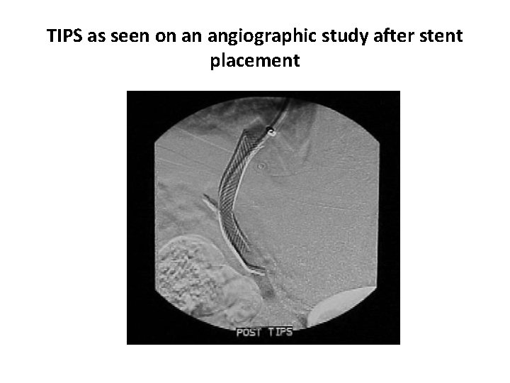 TIPS as seen on an angiographic study after stent placement 