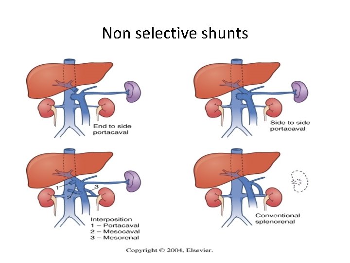 Non selective shunts 