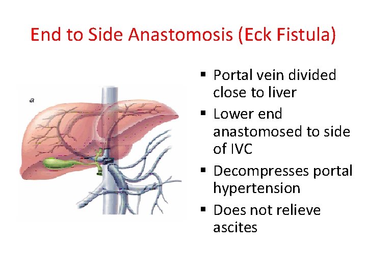 End to Side Anastomosis (Eck Fistula) § Portal vein divided close to liver §
