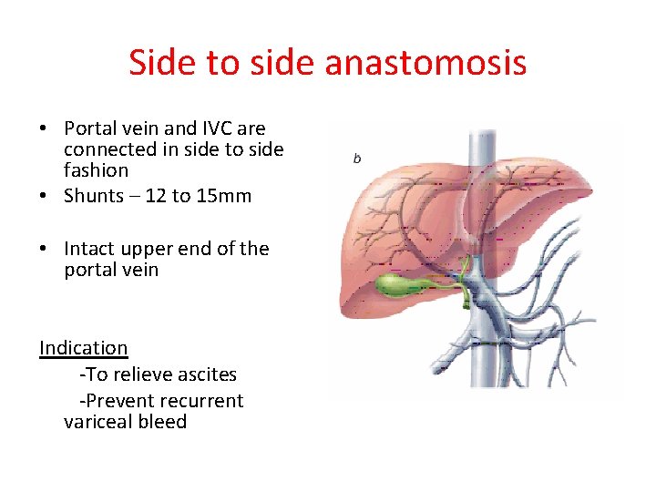 Side to side anastomosis • Portal vein and IVC are connected in side to