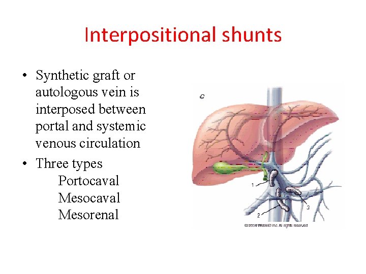 Interpositional shunts • Synthetic graft or autologous vein is interposed between portal and systemic