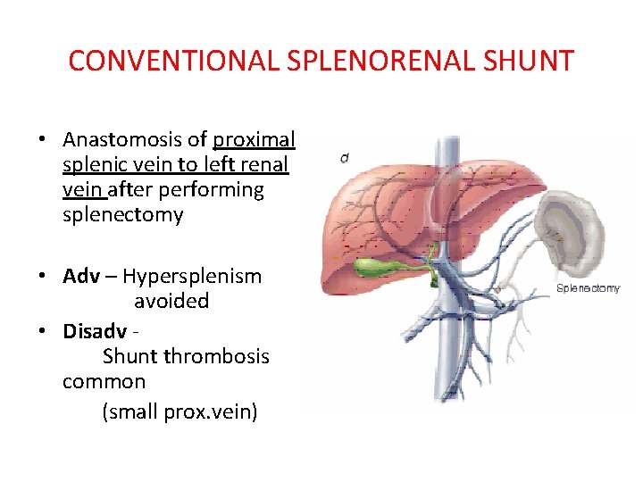 CONVENTIONAL SPLENORENAL SHUNT • Anastomosis of proximal splenic vein to left renal vein after