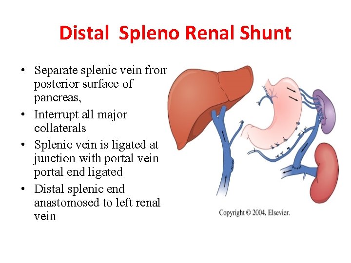 Distal Spleno Renal Shunt • Separate splenic vein from posterior surface of pancreas, •