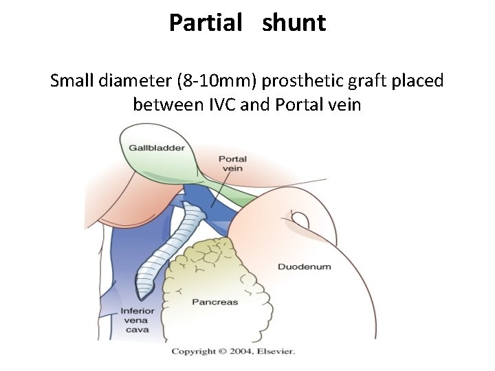 Partial shunt Small diameter (8 -10 mm) prosthetic graft placed between IVC and Portal